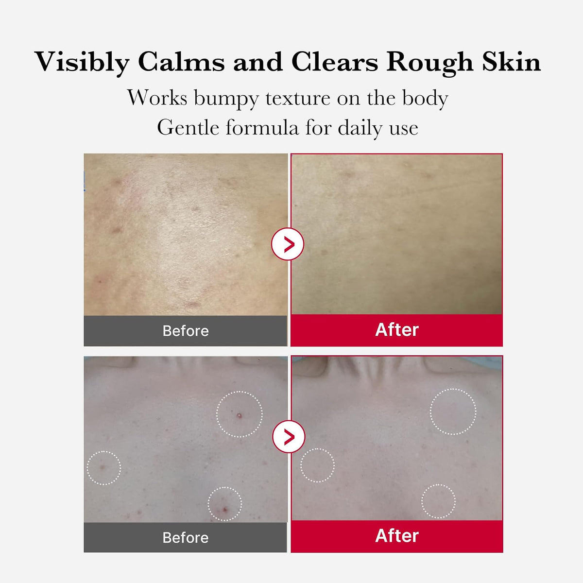 Medicube Red Acne spray exfoliant corps, 110 g