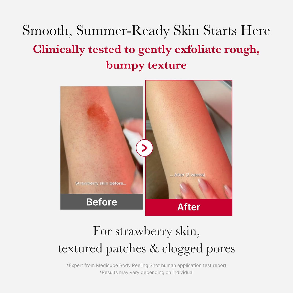 Medicube Red Acne spray exfoliant corps, 110 g